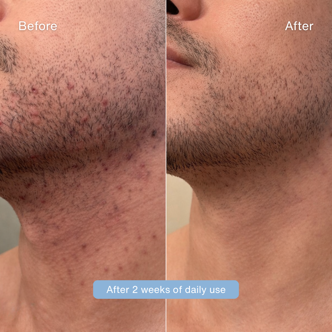 Sirencia® Ingrown Hair Solution