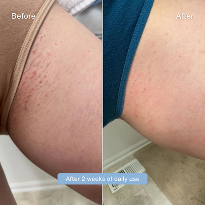 Sirencia® Ingrown Hair Solution