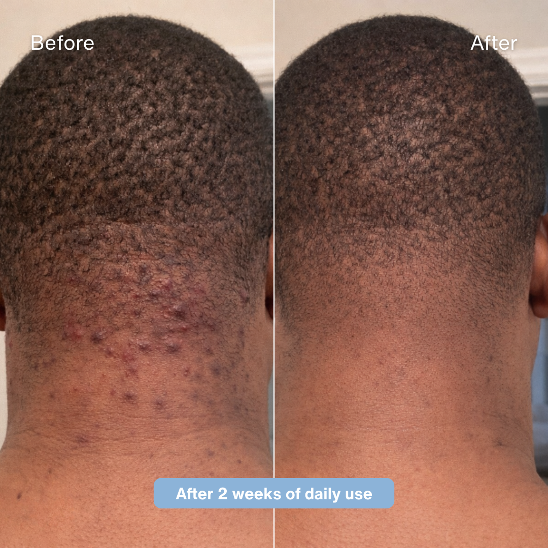 Sirencia® Ingrown Hair Solution